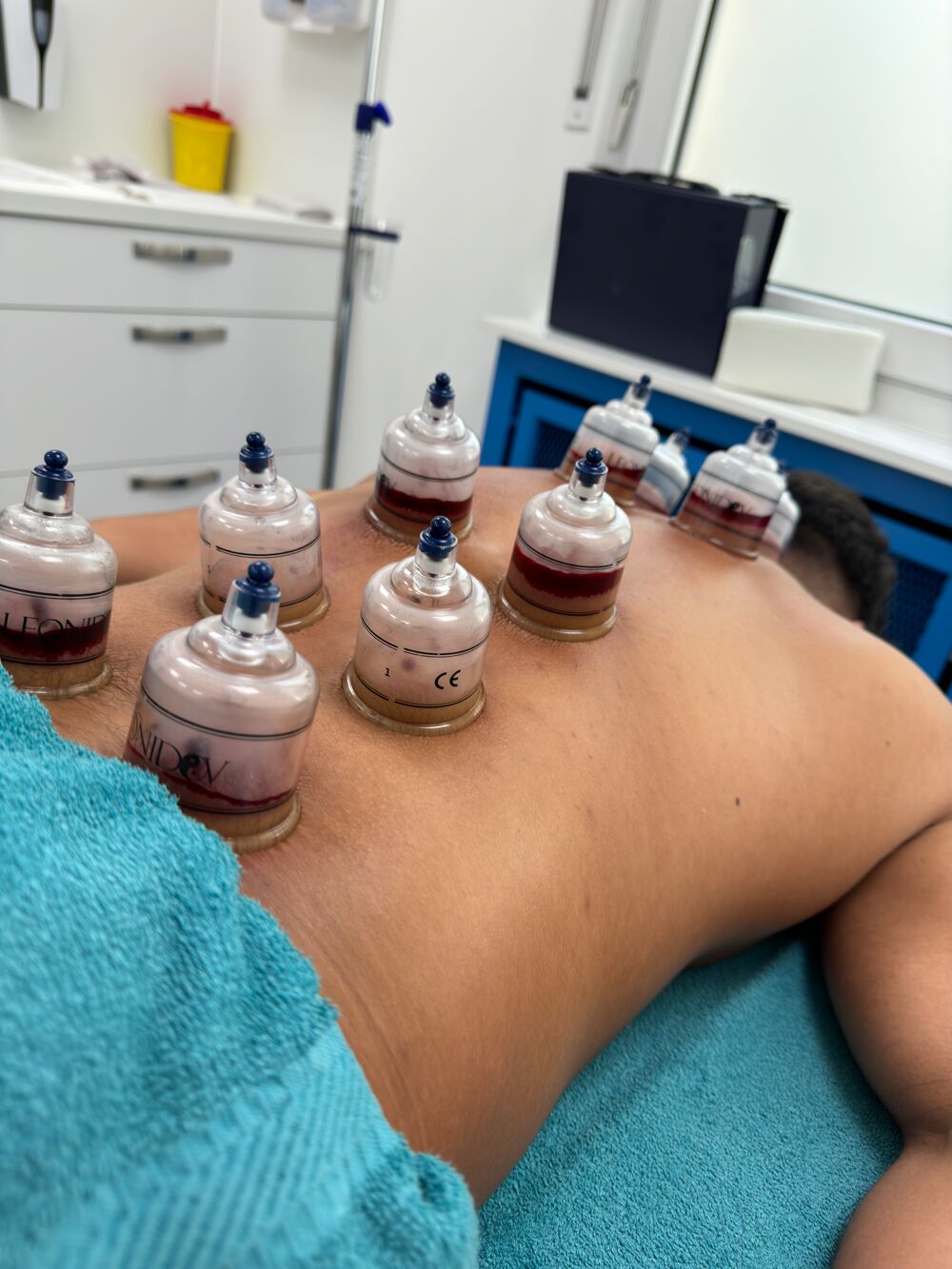 Blut Schröpfen durch unsere Heilpraktikerin